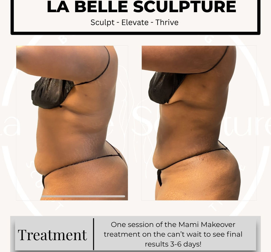 Before and after — Mami Makeover, waist and abdomen