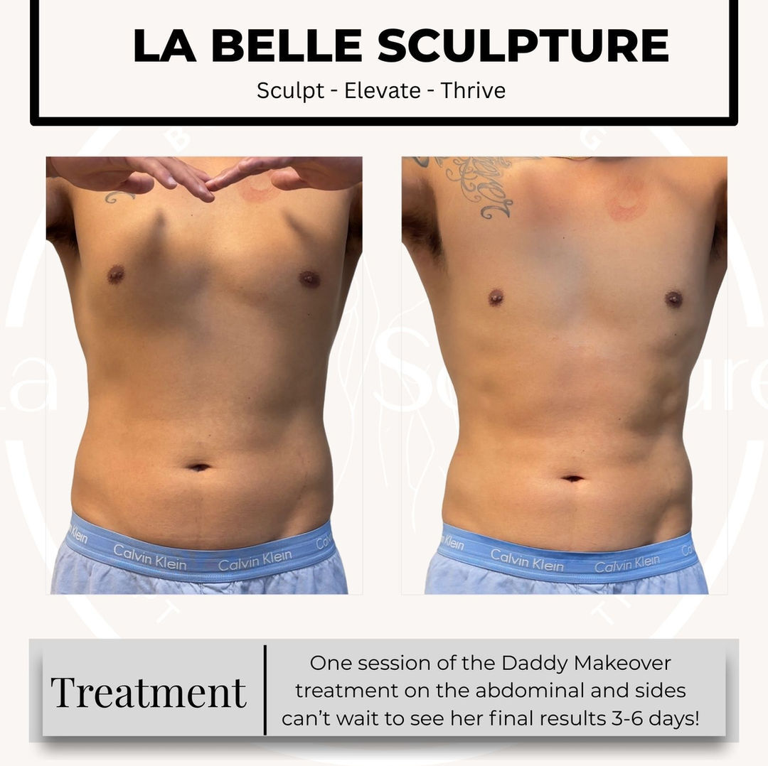 Before and after — Daddy Makeover, abdomen and flanks